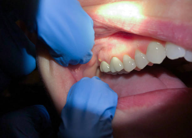 Best Emergency Tooth Extraction in Mccormick, SC